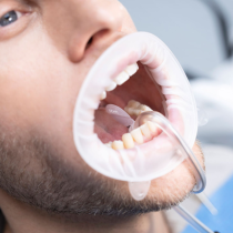 OPTRAGATE DRY CONTROL 60PCS